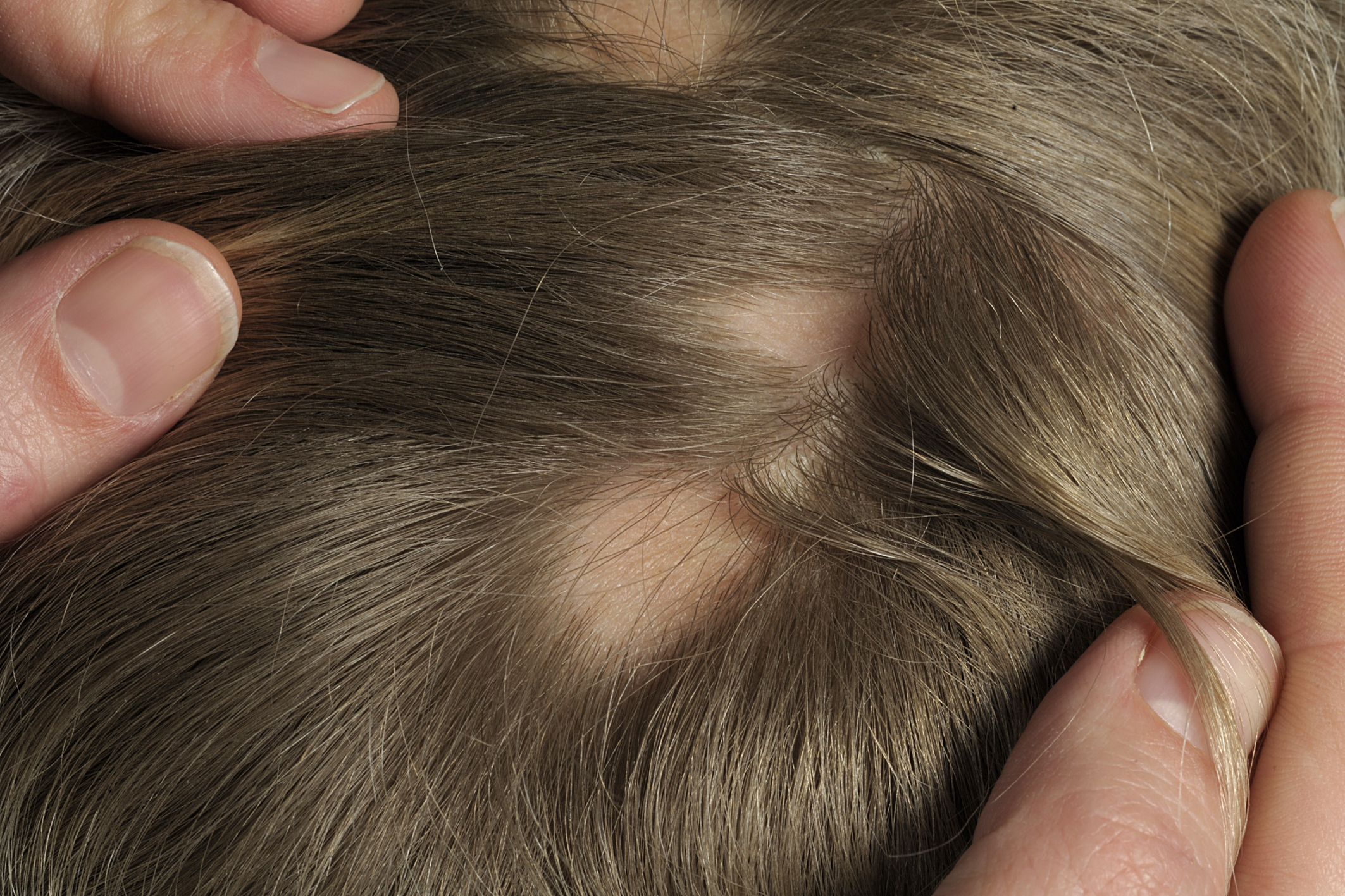 Alopecia Areata